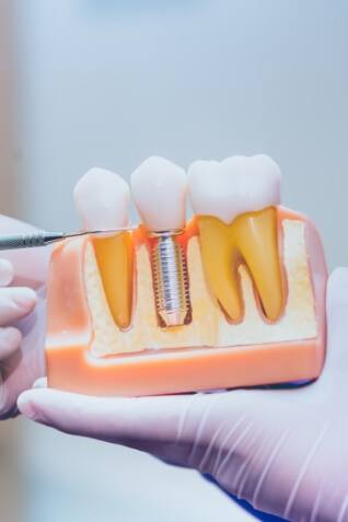 Dentist holding a model of a dental implant in the jaw