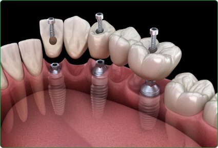 Illustrated five part dental bridge being placed onto three dental implants