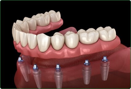 Illustrated full denture being placed onto eight dental implants