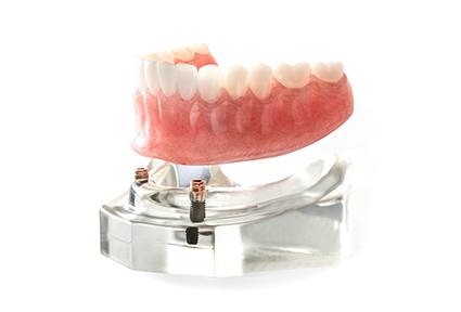Implant dentures over model dental implants