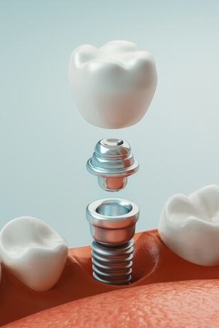 Illustrated dental implant replacing a missing tooth