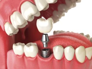 Illustration of a dental implant replacing a lost premolar