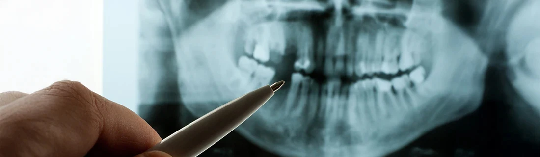 Doctor Pointing To Missing Tooth X-Ray Dental Technology