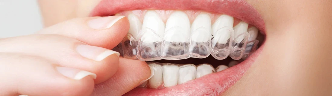 Dentist Yarmouth ME Woman Removing Her Clear Aligner Suresmile Woman Removing Her Clear Aligner Suresmile